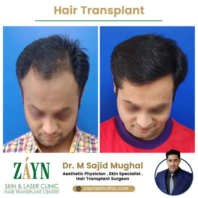 hair transplant clinic in Pune