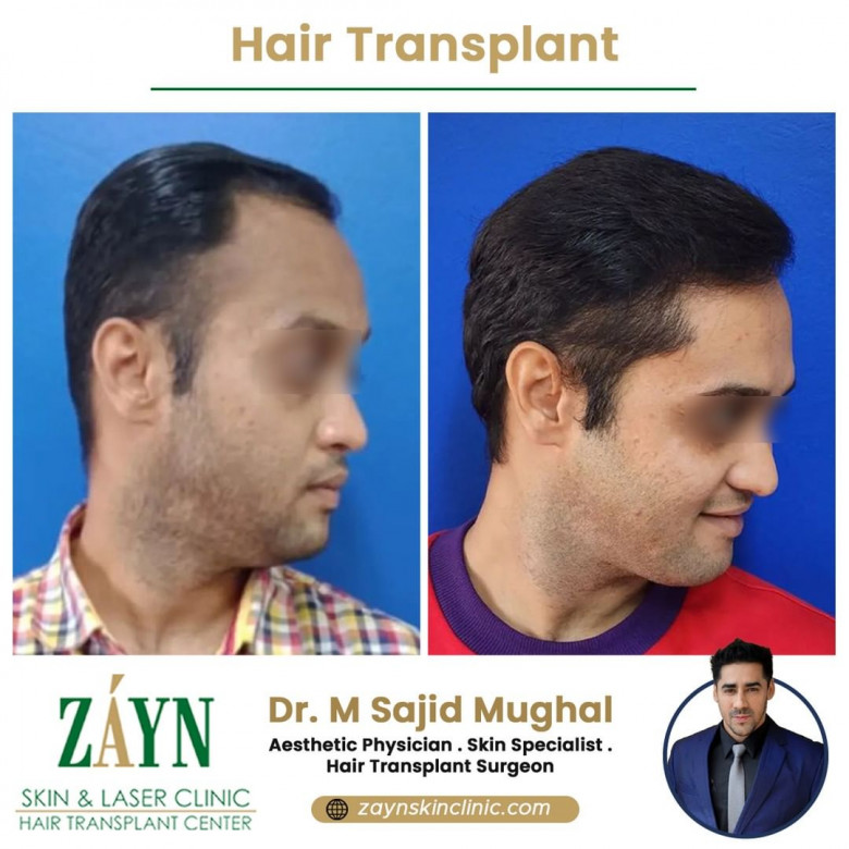 hair transplant clinic in Pune