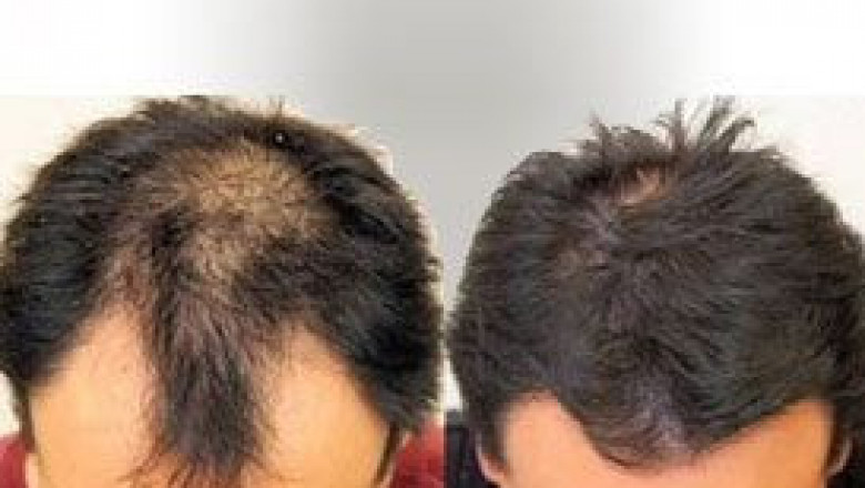 Discover the Right Hair Transplant Clinic in Pune for a Fuller, Natural Look
