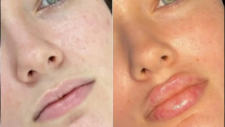 Best Aesthetic Clinics in Dubai for Fillers with Stunning Before and After