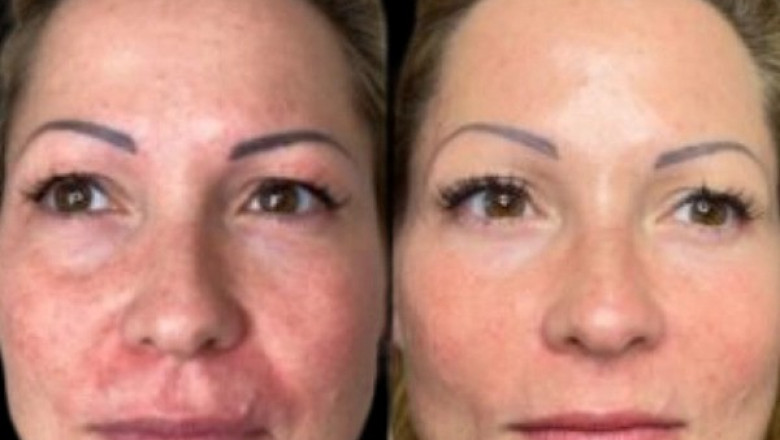 Best Aesthetic Clinics in Dubai for Profhilo: A Revolutionary Treatment for Skin Laxity