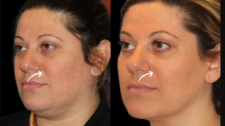 Facial Harmonization Using Sculptra Fillers at the Best Aesthetic Clinics in Dubai