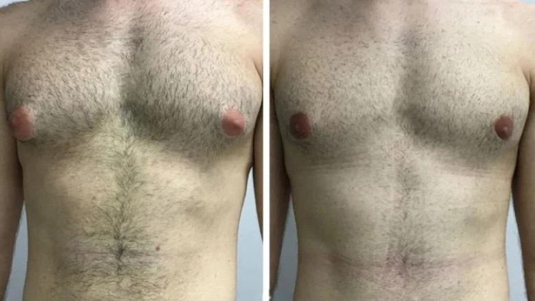 How Gynecomastia in Dubai Affects Men's Confidence and Self-Esteem