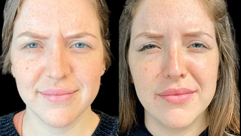 How Often Should You Get Botox? Advice from the Best Aesthetic Clinics in dubai