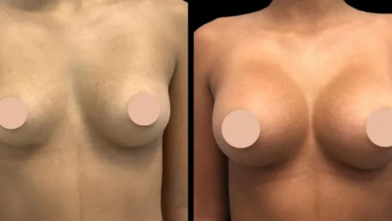 Is Breast Augmentation in Dubai Right for You Things to Consider Before Surgery
