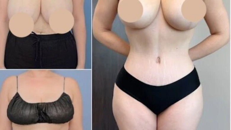 Safe and Effective Body Contouring in Dubai: Patient Success Stories