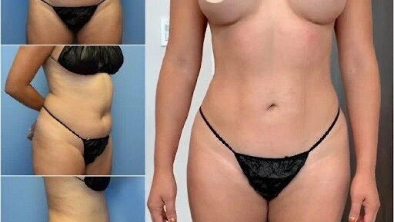 Tummy Tuck in Dubai: What You Should Know About Post-Surgery Care