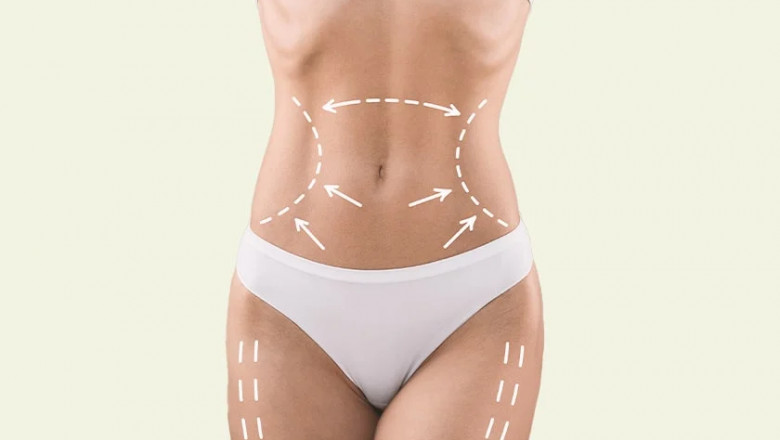 Tummy Tuck Surgery in Dubai: Recovery Tips and What to Know for a Smooth Healing Process
