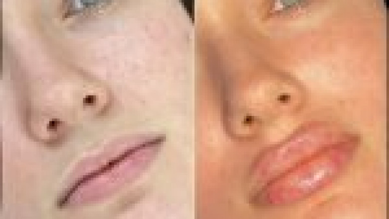 Are Russian Lip Fillers in Dubai Right for You? What to Consider
