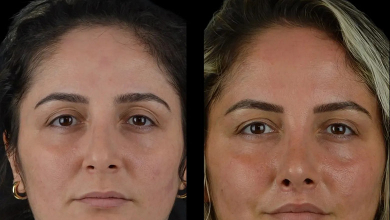 Can You Combine Cheek Fillers in Dubai with Other Aesthetic Treatments?