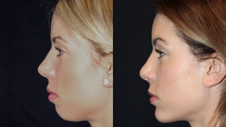 Chin Fillers in Dubai Perfect Your Facial Contours
