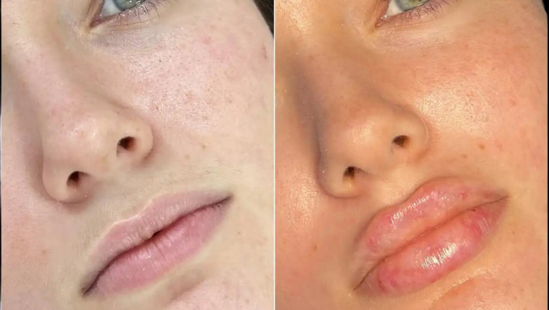 Exploring the Different Types of Fillers in Dubai and Their Benefits