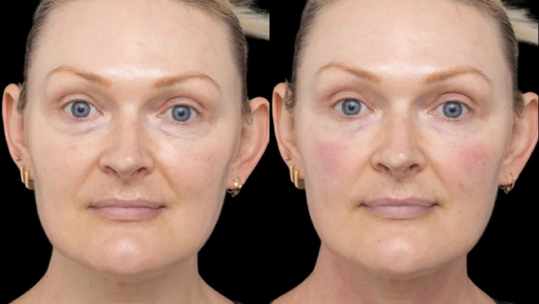 How Long Do Under Eye Fillers in Dubai Last?