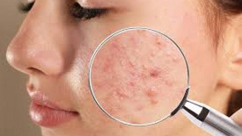 Rising Awareness and Cosmetic Concerns Propel Acne Treatment Market Growth Through 2035