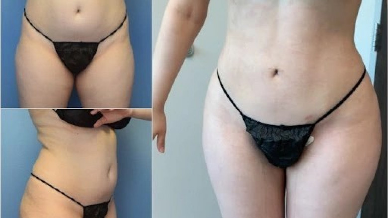 Mental and Physical Recovery After Liposuction Surgery in Dubai