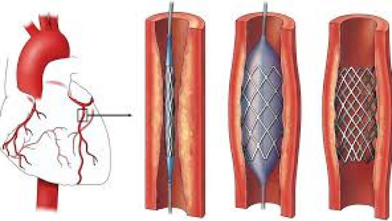 Percutaneous Coronary Intervention Market Growth Analysis and Strategic Outlook 2025–2034