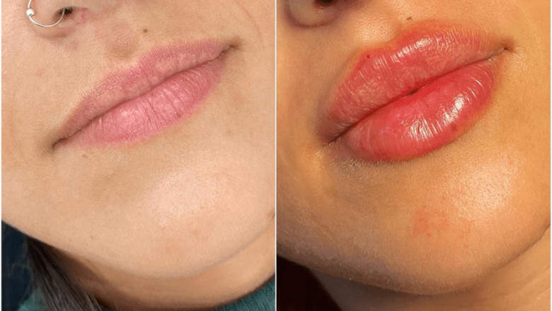 How Juvederm Helps You Look Younger and Fresher: A Detailed Guide from the Best Plastic Surgeon in dubai