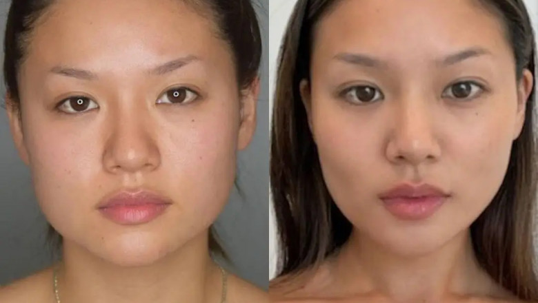 How Buccal Fat Removal Helps with Facial Slimming: Best Doctors in Dubai Discuss
