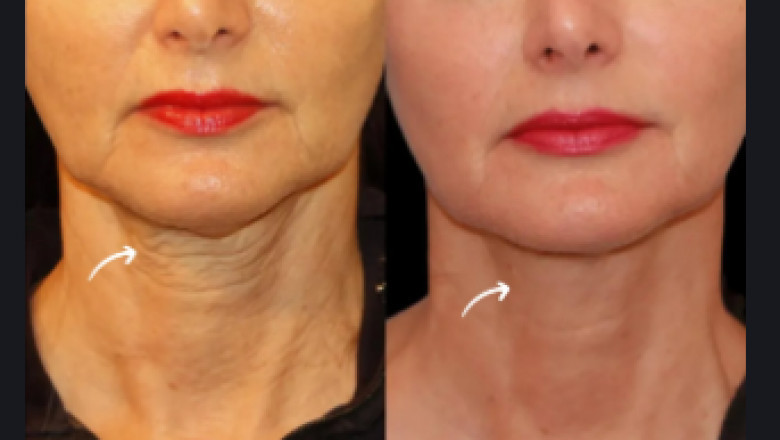 Best Doctors in Dubai Recommend Sculptra Fillers for Sagging Skin