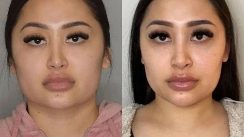 How to Avoid Complications After Buccal Fat Removal: Best Doctors in Dubai Guide