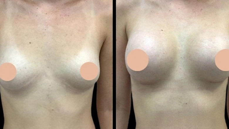 Cost Factors to Consider for Breast Augmentation in Dubai