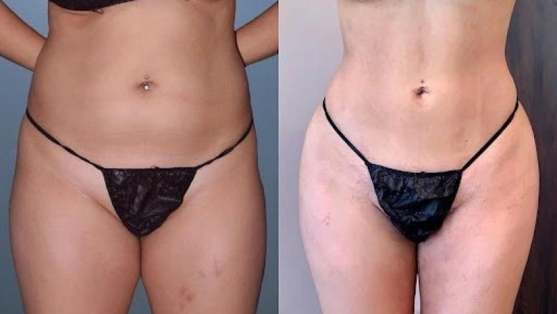 From Theory to Transformation The Science Driving Liposuction in Dubai