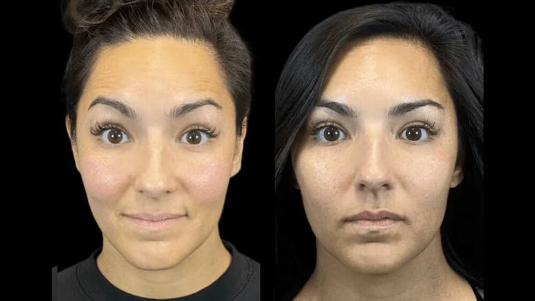Why the Best Aesthetic Clinic in dubai is the Go-To Place for Natural-Looking Botox