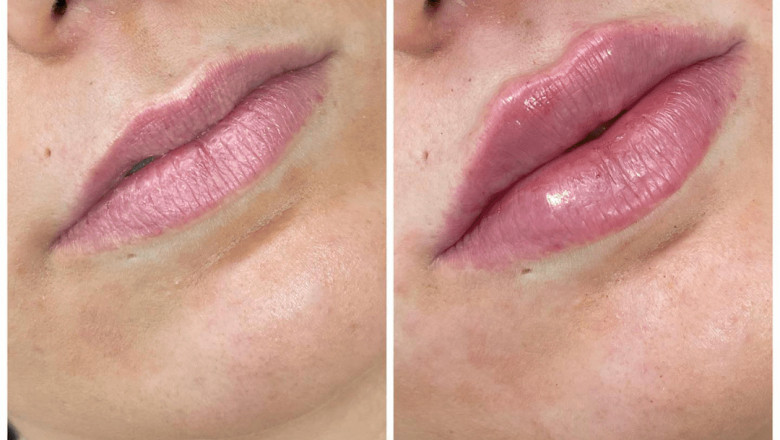 Best Aesthetic Clinics in dubai for Juvederm Anti-Aging Treatments