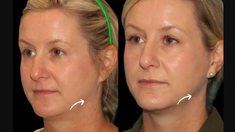 Injection Techniques for Sculptra Fillers Used by the Best Aesthetic Clinics in Dubai