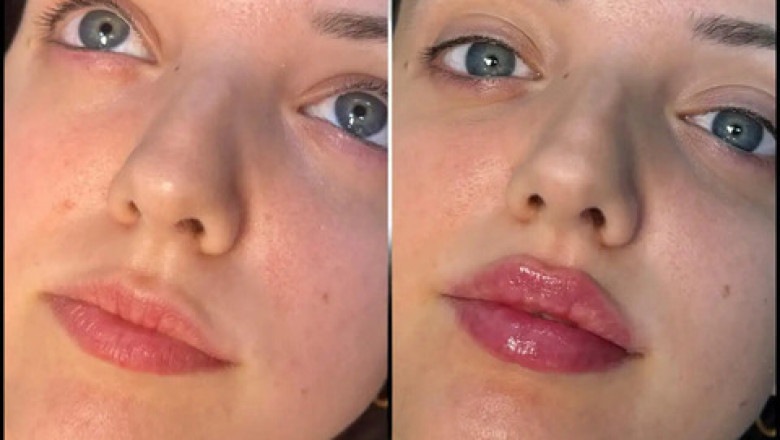 Best Aesthetic Clinics in dubai for Fillers: Tips for Longevity of Results